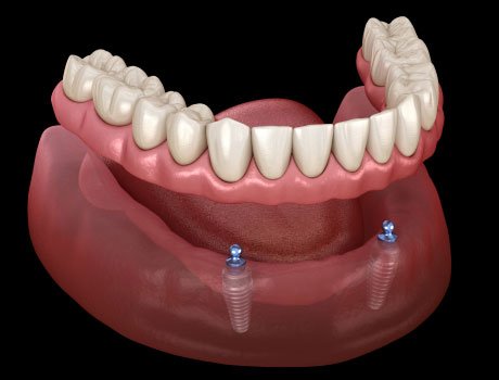 2 Implants Overdenture