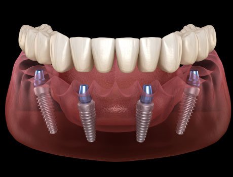 4 Implants Overdenture